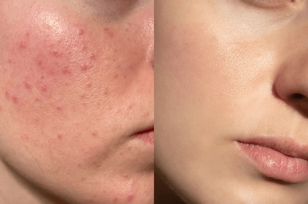 Lumenoraskin Facial Cleansing Brush™